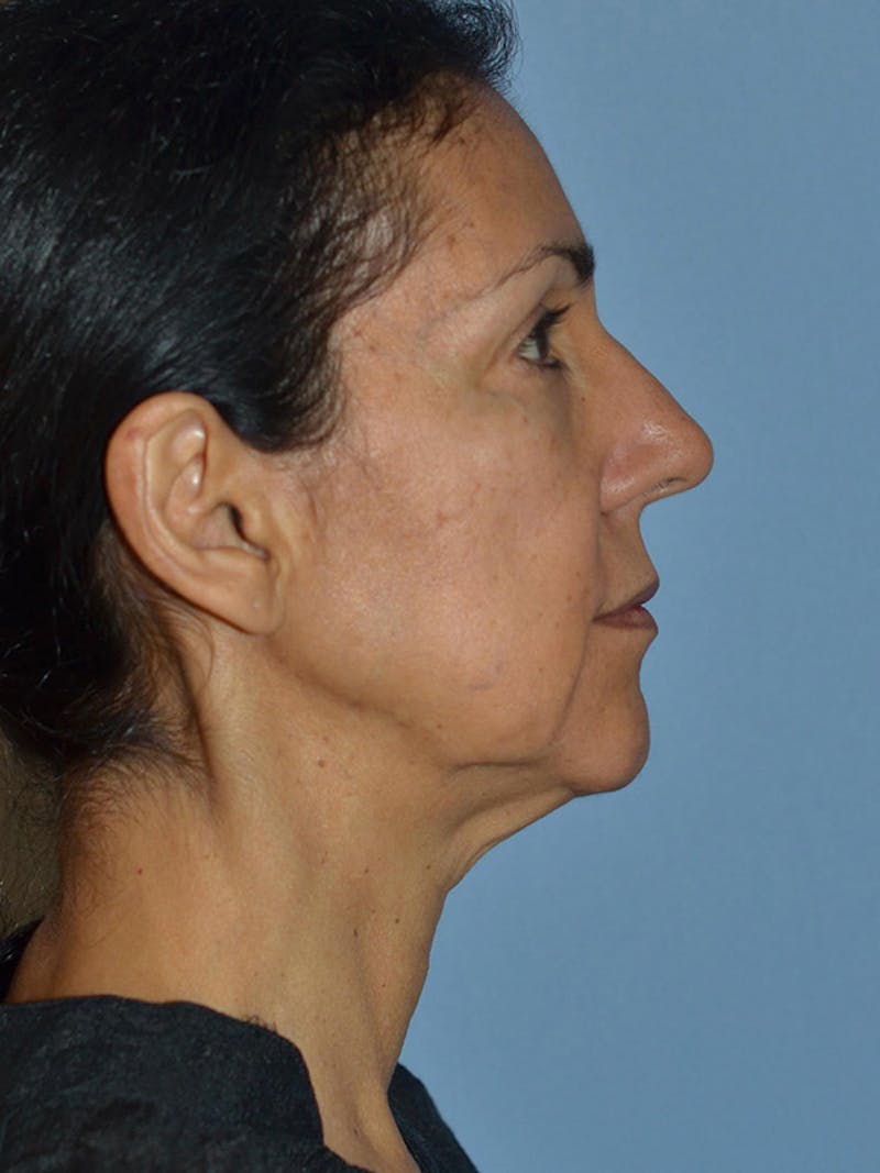 Lower Face & Neck Lift Before & After Gallery - Patient 140324 - Image 3