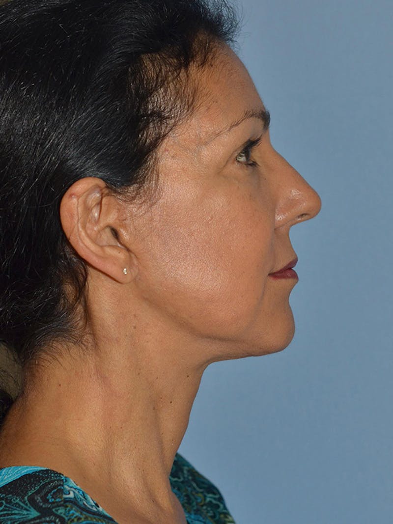 Lower Face & Neck Lift Before & After Gallery - Patient 140324 - Image 4