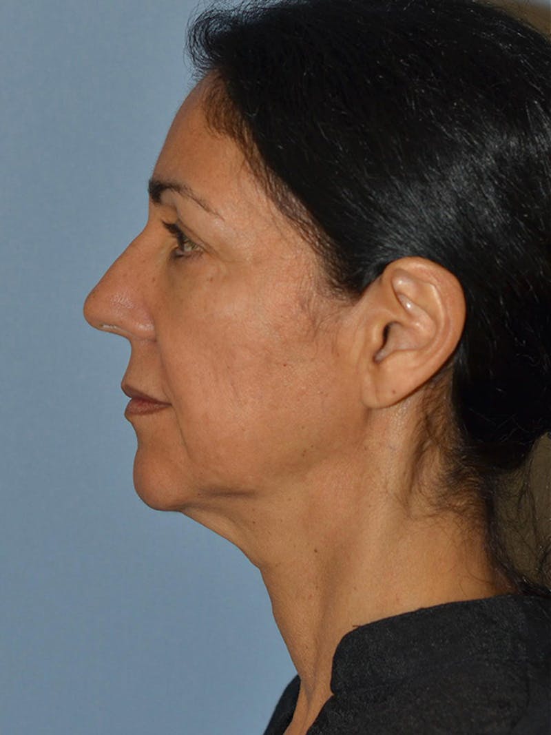 Lower Face & Neck Lift Before & After Gallery - Patient 140324 - Image 5