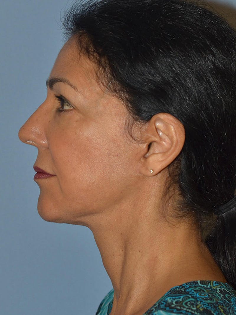 Lower Face & Neck Lift Before & After Gallery - Patient 140324 - Image 6