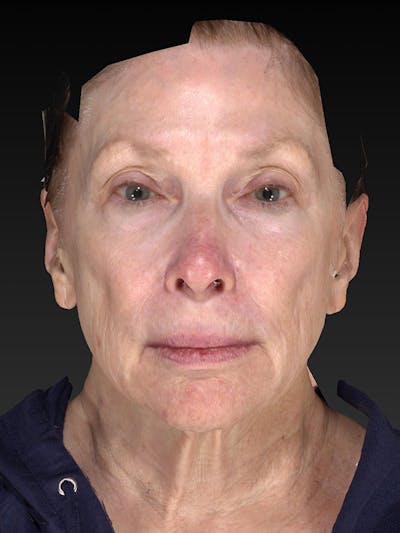 Lower Face & Neck Lift Before & After Gallery - Patient 410284 - Image 1