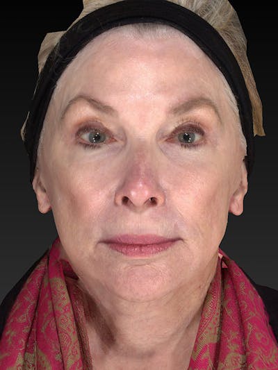 Lower Face & Neck Lift Before & After Gallery - Patient 410284 - Image 2