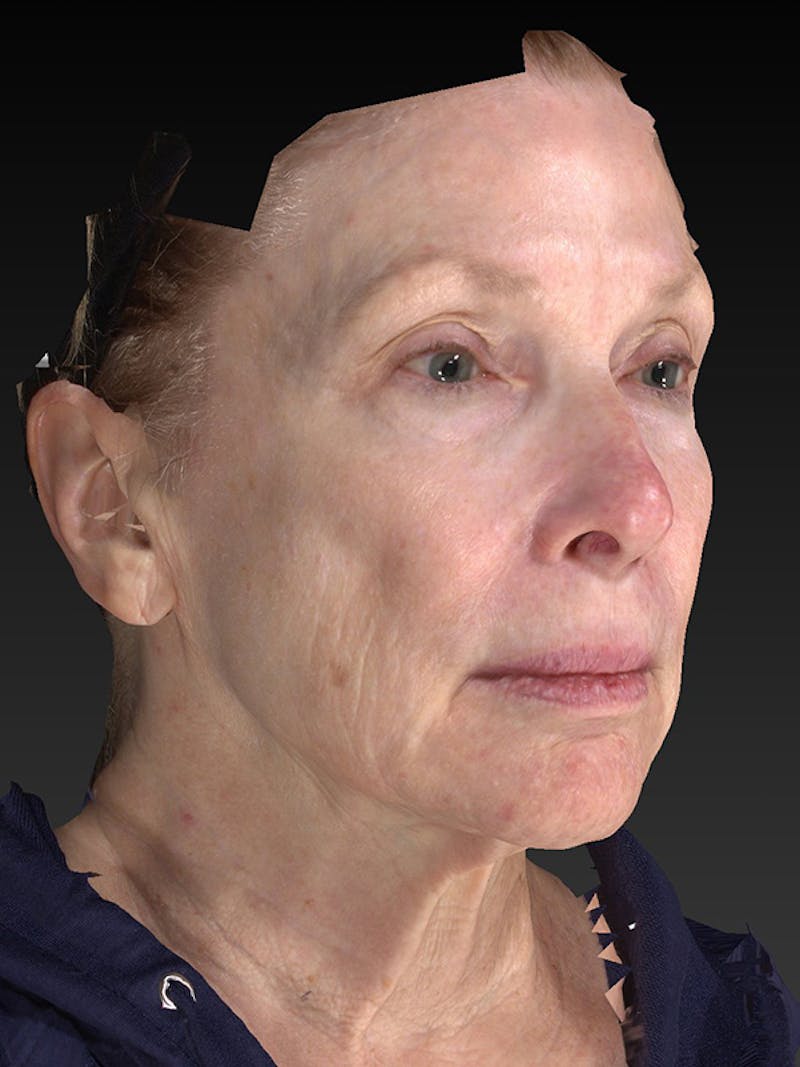 Lower Face & Neck Lift Before & After Gallery - Patient 410284 - Image 3
