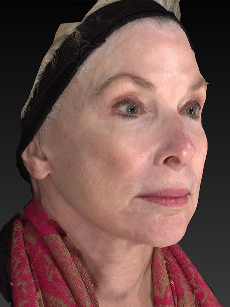 Lower Face & Neck Lift Before & After Gallery - Patient 410284 - Image 4
