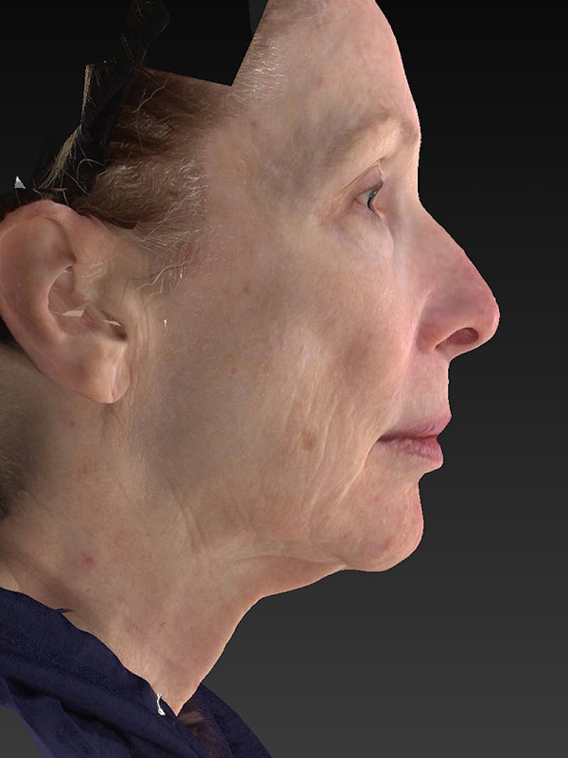 Lower Face & Neck Lift Before & After Gallery - Patient 410284 - Image 5
