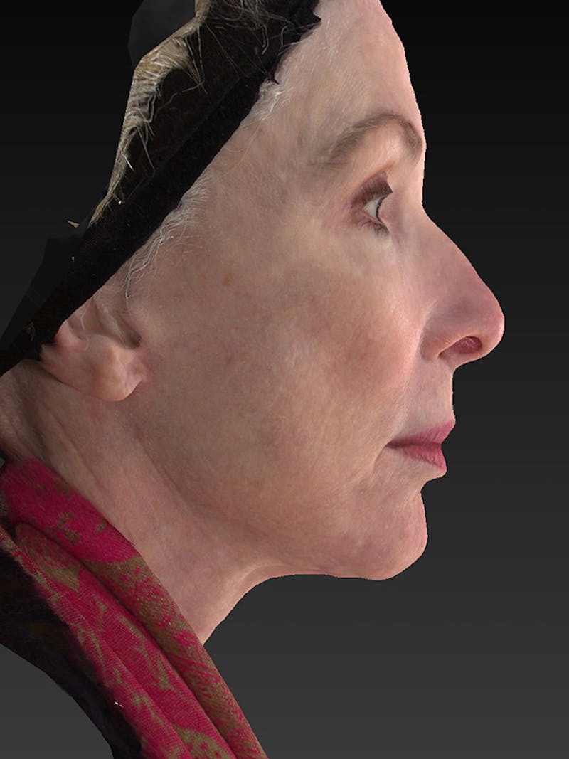 Lower Face & Neck Lift Before & After Gallery - Patient 410284 - Image 6