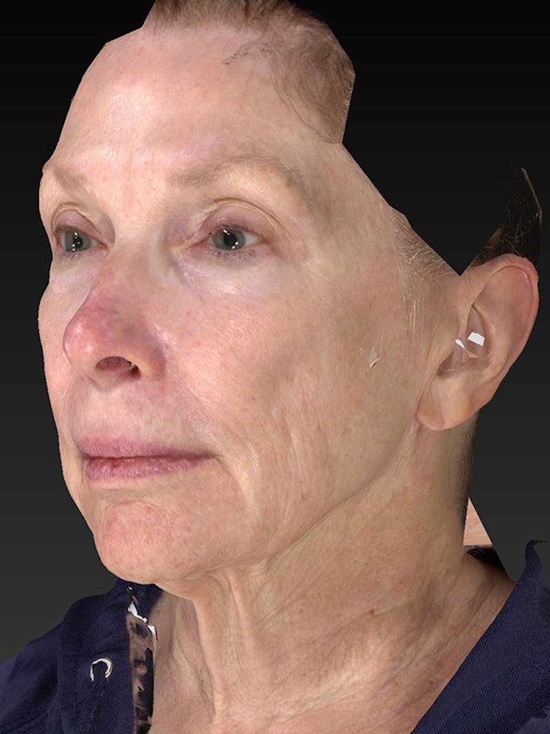 Lower Face & Neck Lift Before & After Gallery - Patient 410284 - Image 7
