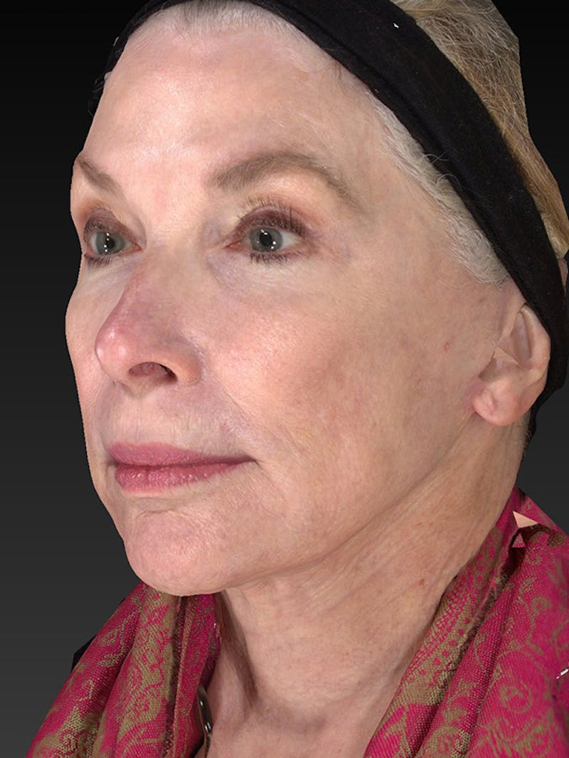 Lower Face & Neck Lift Before & After Gallery - Patient 410284 - Image 8