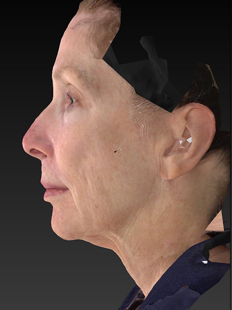 Lower Face & Neck Lift Before & After Gallery - Patient 410284 - Image 9