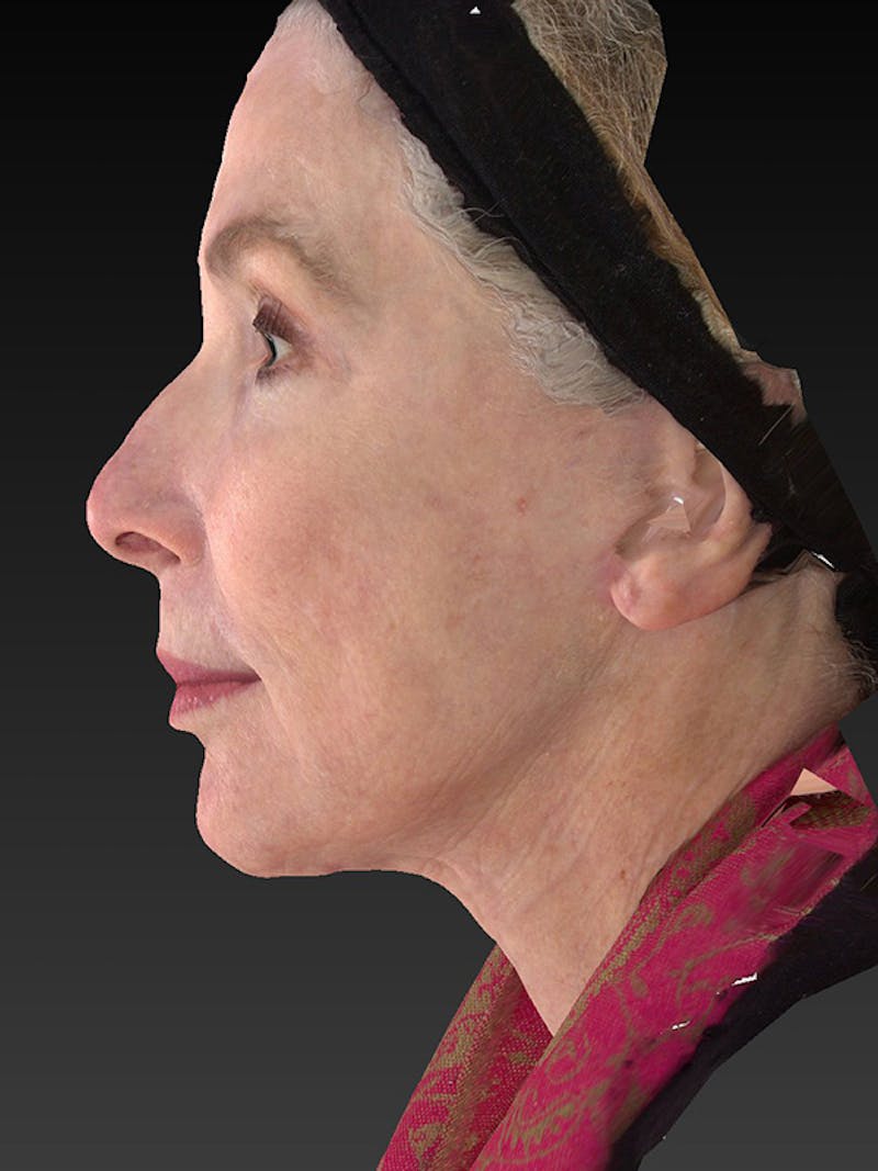 Lower Face & Neck Lift Before & After Gallery - Patient 410284 - Image 10