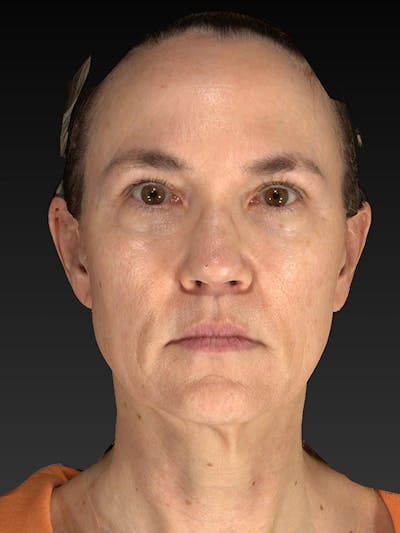 Lower Face & Neck Lift Before & After Gallery - Patient 386651 - Image 1