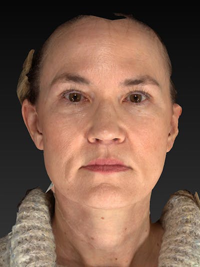 Lower Face & Neck Lift Before & After Gallery - Patient 386651 - Image 2