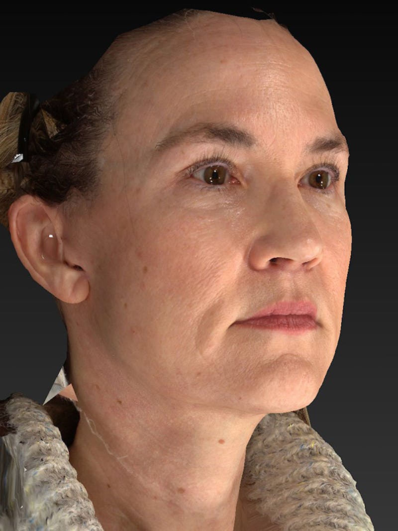 Lower Face & Neck Lift Before & After Gallery - Patient 386651 - Image 4