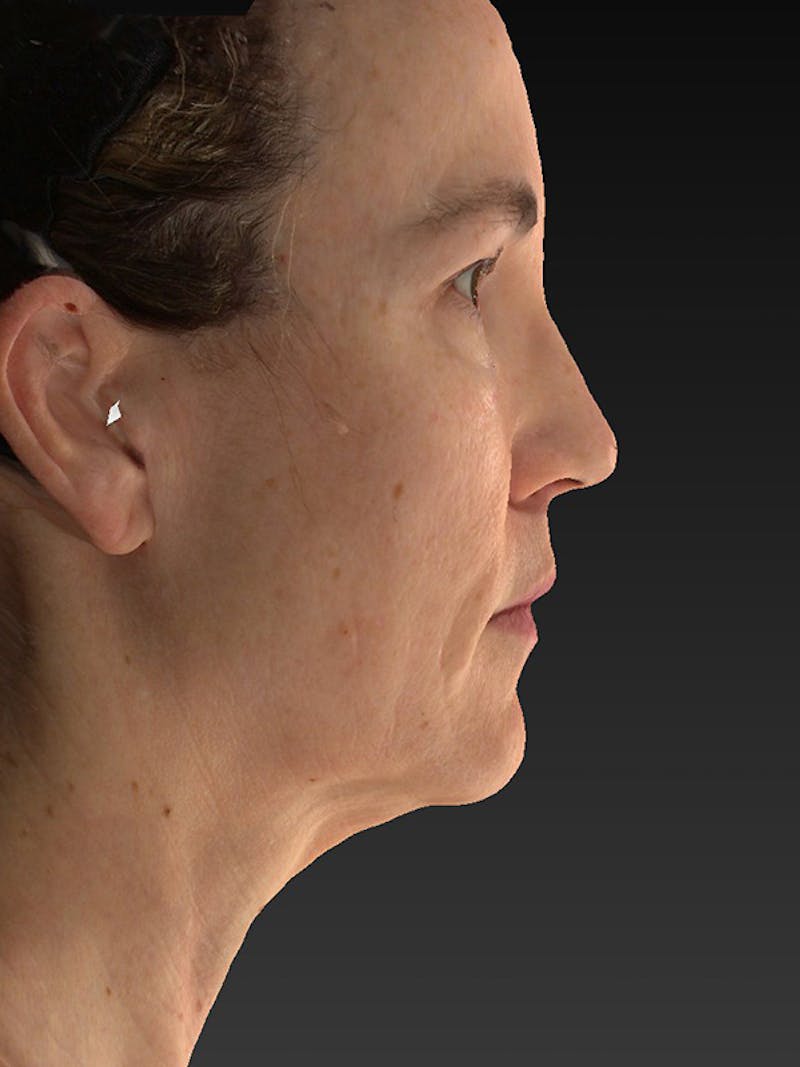 Lower Face & Neck Lift Before & After Gallery - Patient 386651 - Image 5