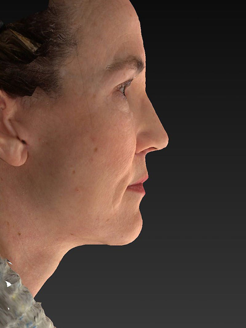 Lower Face & Neck Lift Before & After Gallery - Patient 386651 - Image 6