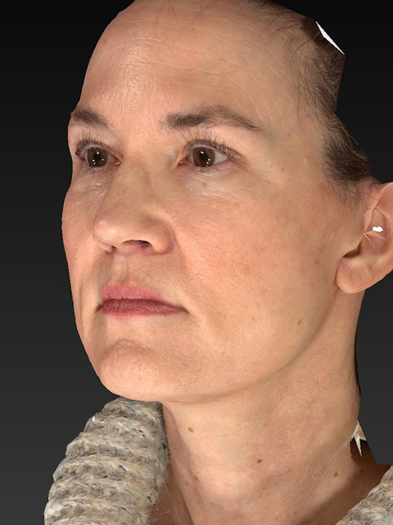 Lower Face & Neck Lift Before & After Gallery - Patient 386651 - Image 8