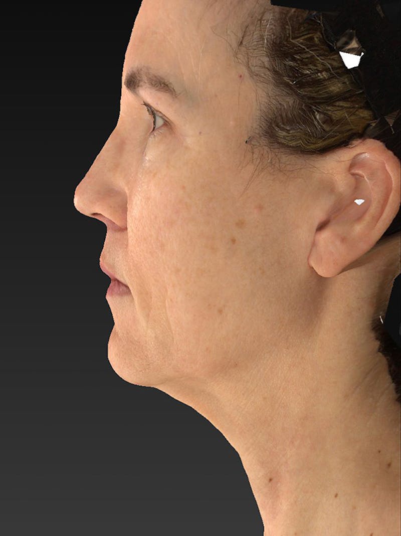 Lower Face & Neck Lift Before & After Gallery - Patient 386651 - Image 9