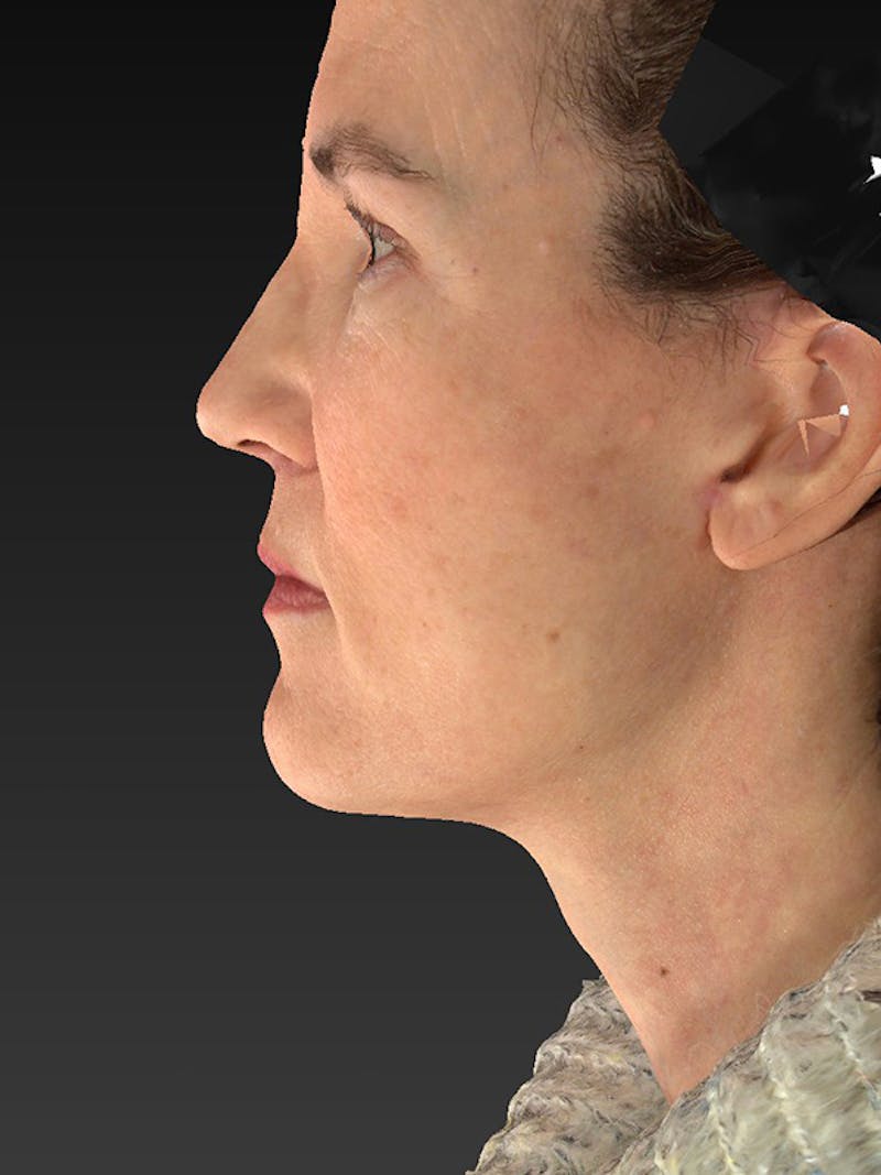 Lower Face & Neck Lift Before & After Gallery - Patient 386651 - Image 10