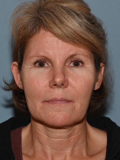 Lower Face & Neck Lift Before & After Gallery - Patient 116764 - Image 1