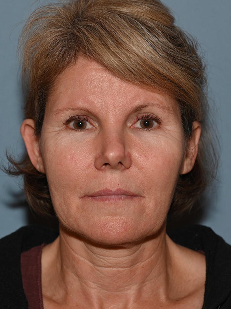 Lower Face & Neck Lift Before & After Gallery - Patient 116764 - Image 1