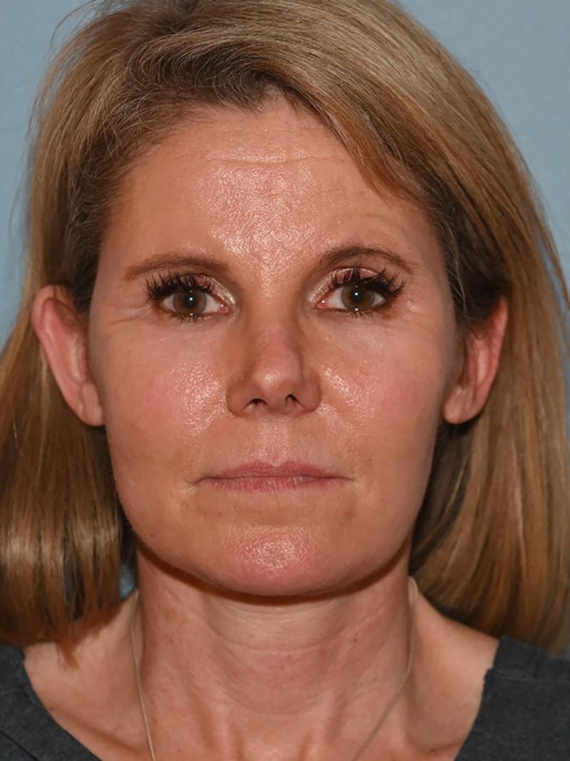 Lower Face & Neck Lift Before & After Gallery - Patient 116764 - Image 2