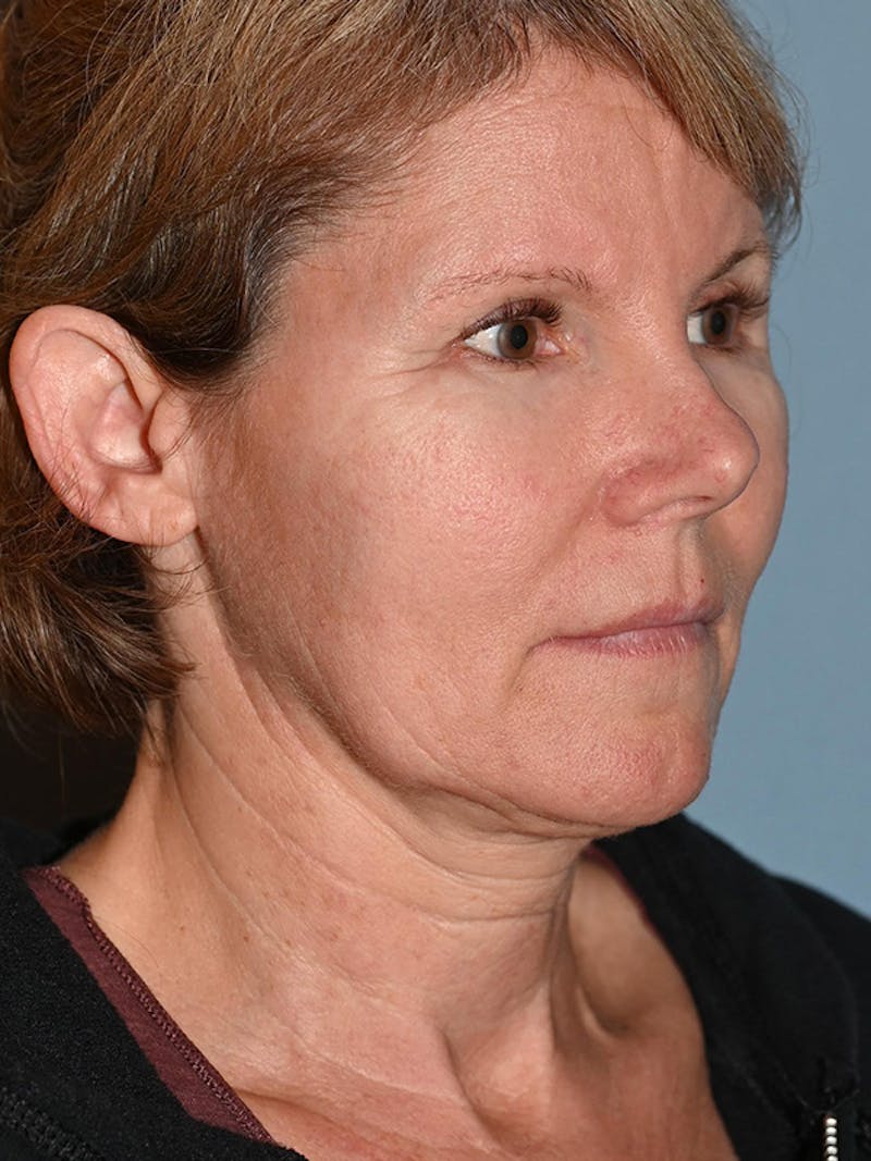 Lower Face & Neck Lift Before & After Gallery - Patient 116764 - Image 3