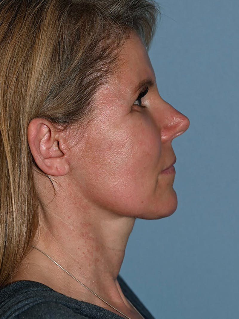 Lower Face & Neck Lift Before & After Gallery - Patient 116764 - Image 6