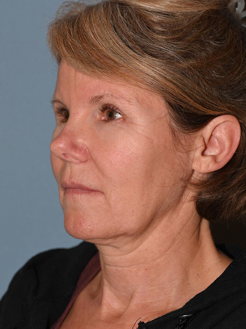 Lower Face & Neck Lift Before & After Gallery - Patient 116764 - Image 7