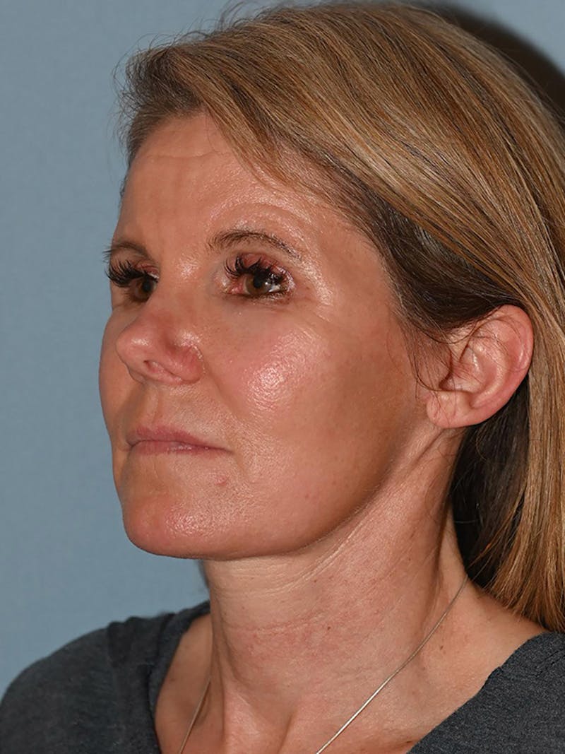 Lower Face & Neck Lift Before & After Gallery - Patient 116764 - Image 8