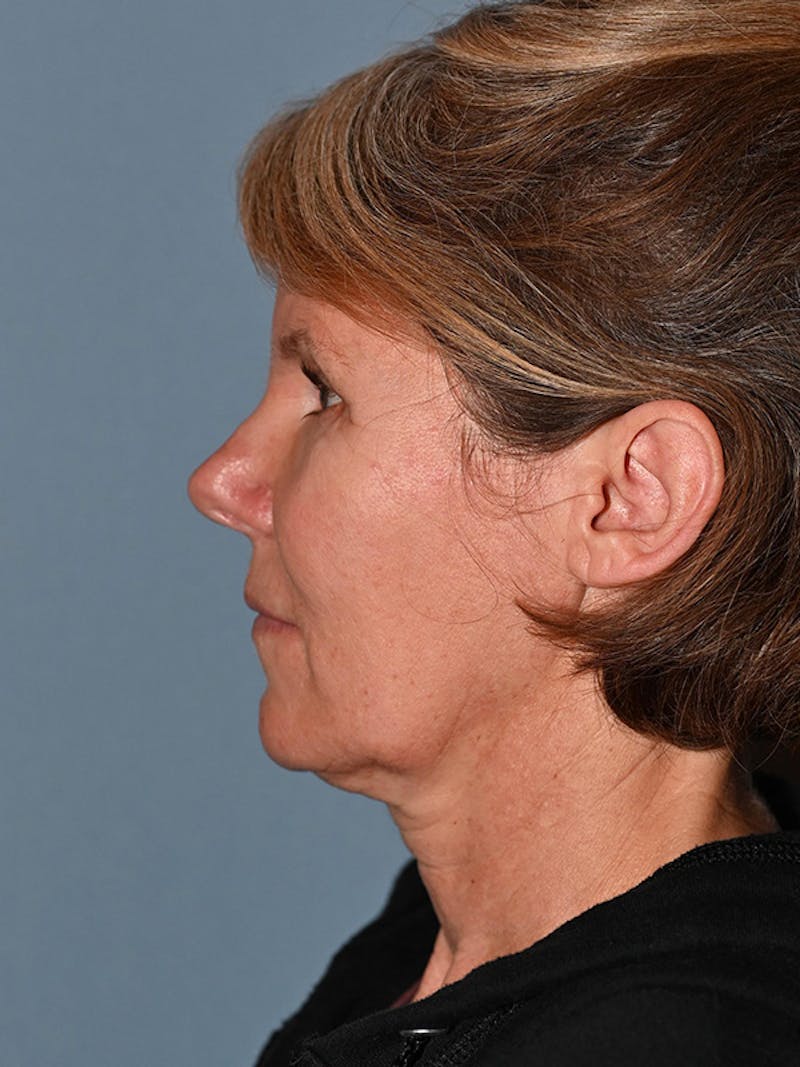 Lower Face & Neck Lift Before & After Gallery - Patient 116764 - Image 9
