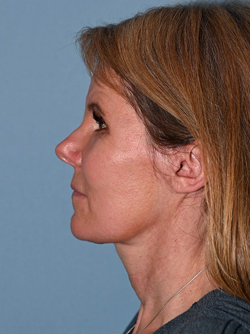 Lower Face & Neck Lift Before & After Gallery - Patient 116764 - Image 10
