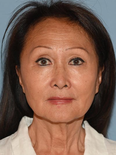 Lower Face & Neck Lift Before & After Gallery - Patient 320870 - Image 1