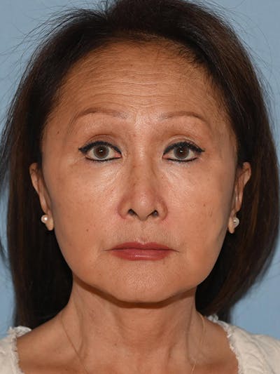 Lower Face & Neck Lift Before & After Gallery - Patient 320870 - Image 2