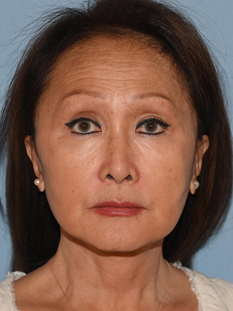 Lower Face & Neck Lift Before & After Gallery - Patient 320870 - Image 2