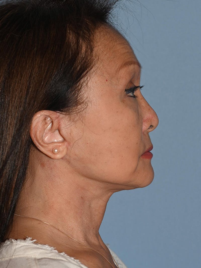 Lower Face & Neck Lift Before & After Gallery - Patient 320870 - Image 4