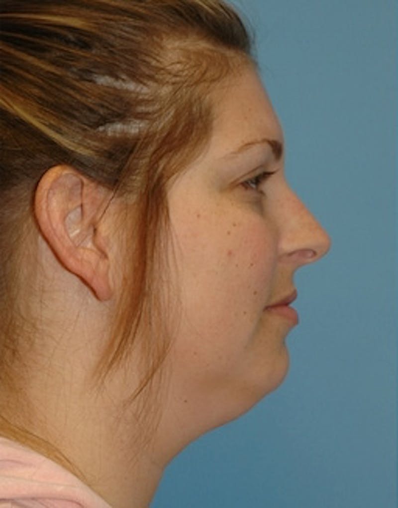 Lower Face & Neck Lift Before & After Gallery - Patient 329443 - Image 1