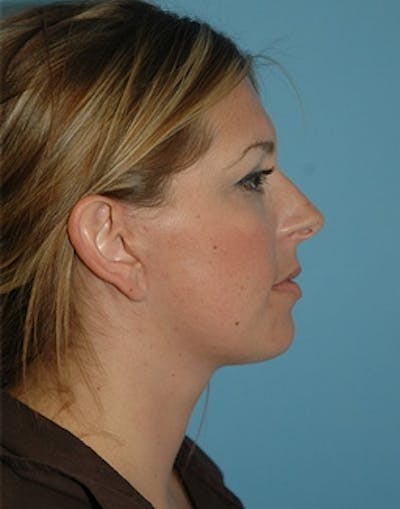 Lower Face & Neck Lift Before & After Gallery - Patient 329443 - Image 2