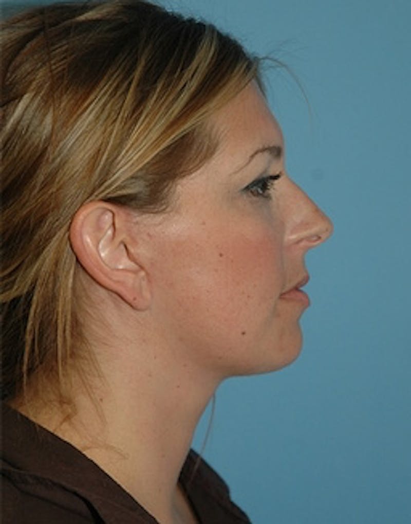 Lower Face & Neck Lift Before & After Gallery - Patient 329443 - Image 2