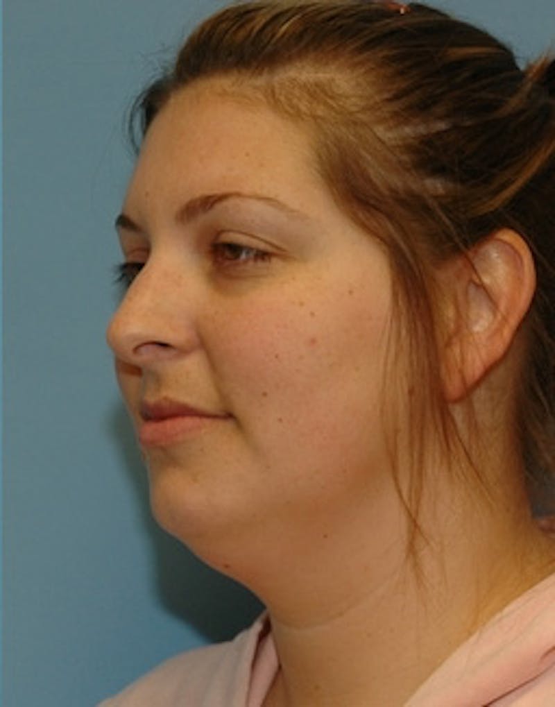 Lower Face & Neck Lift Before & After Gallery - Patient 329443 - Image 3