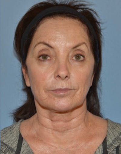 Lower Face & Neck Lift Before & After Gallery - Patient 140704 - Image 1