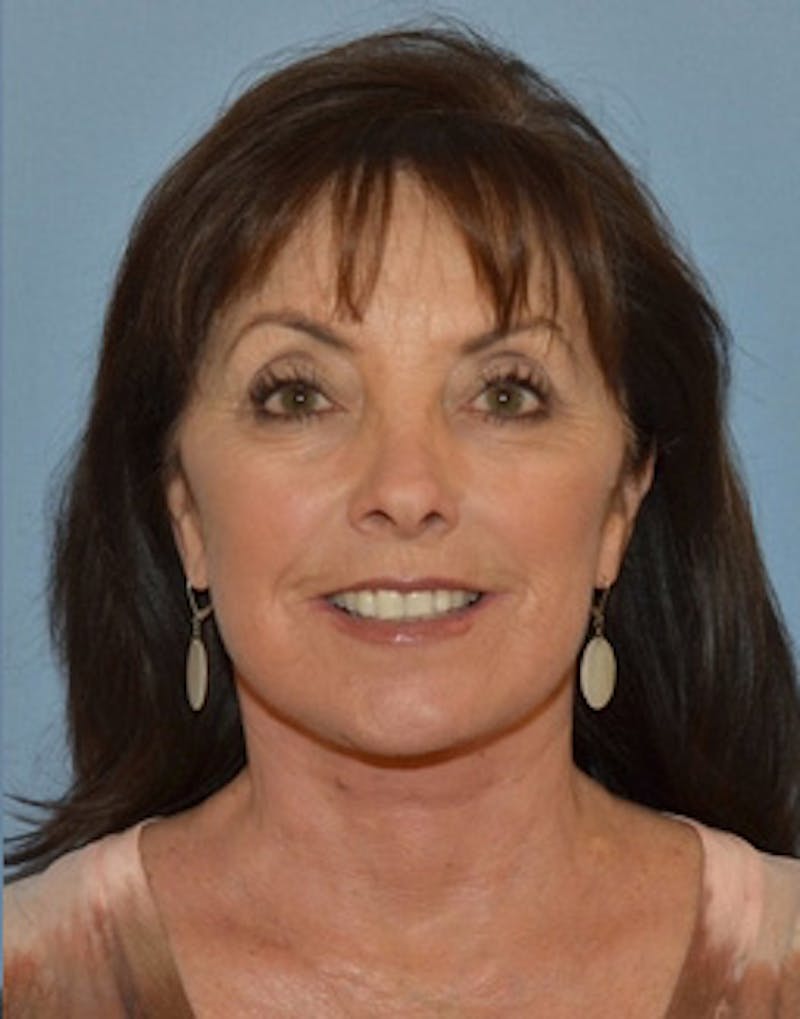 Lower Face & Neck Lift Before & After Gallery - Patient 140704 - Image 2