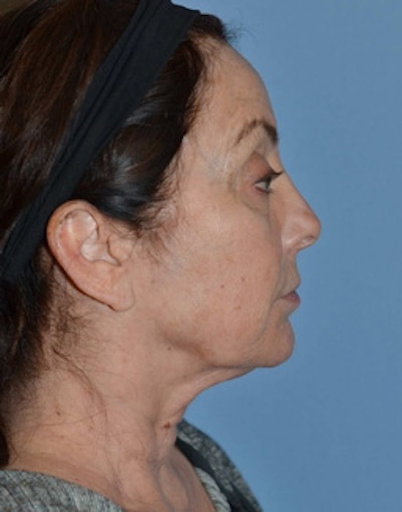 Lower Face & Neck Lift Before & After Gallery - Patient 140704 - Image 5