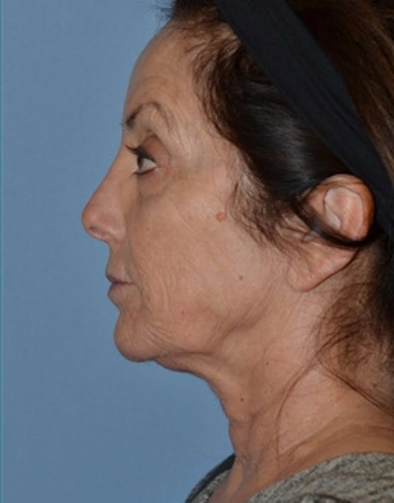 Lower Face & Neck Lift Before & After Gallery - Patient 140704 - Image 7