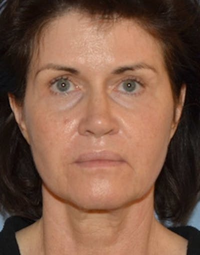 Lower Face & Neck Lift Before & After Gallery - Patient 350619 - Image 1