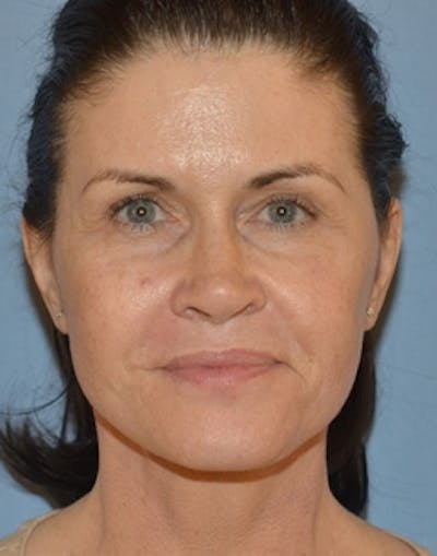 Lower Face & Neck Lift Before & After Gallery - Patient 350619 - Image 2