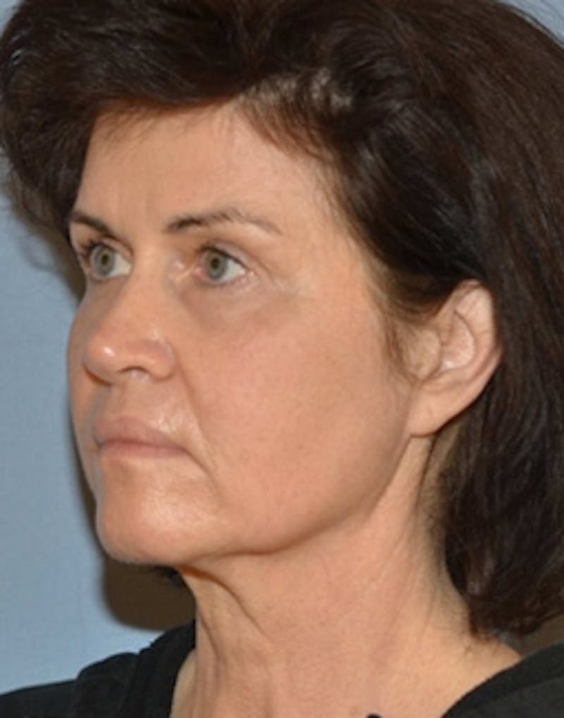 Lower Face & Neck Lift Before & After Gallery - Patient 350619 - Image 3