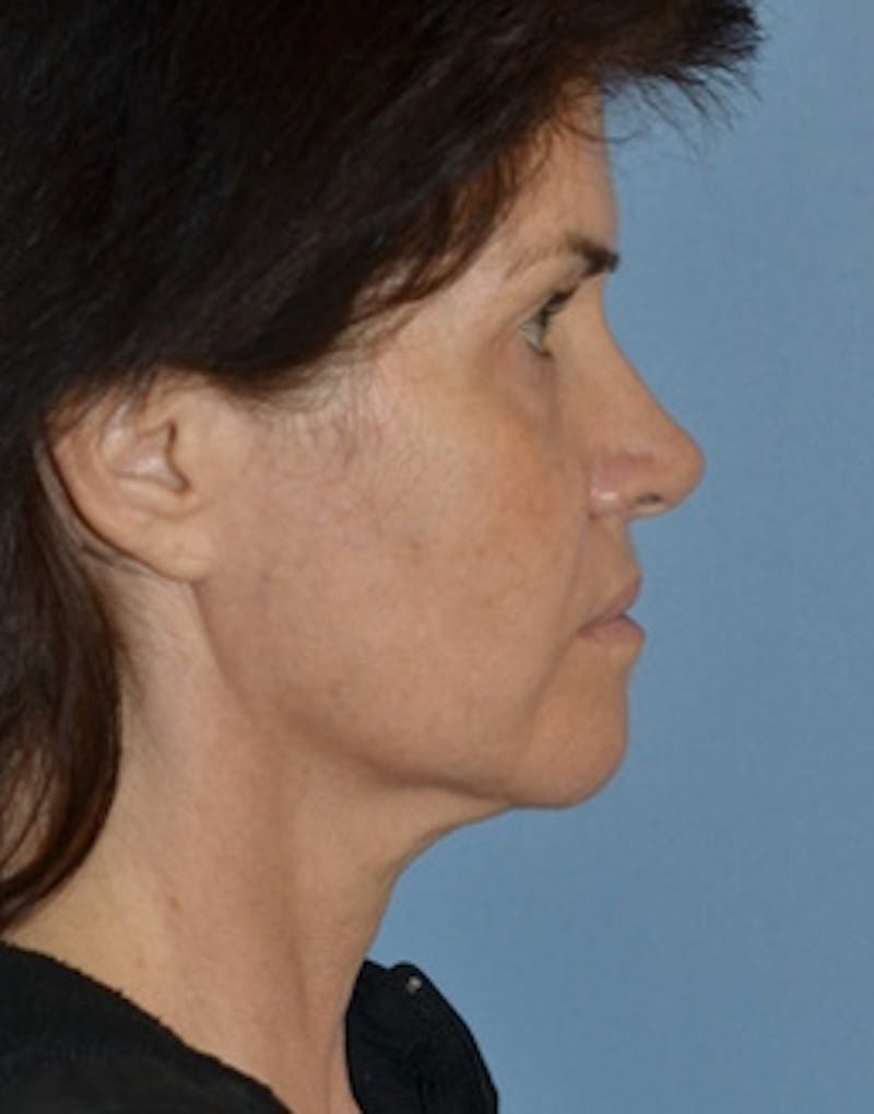 Lower Face & Neck Lift Before & After Gallery - Patient 350619 - Image 5