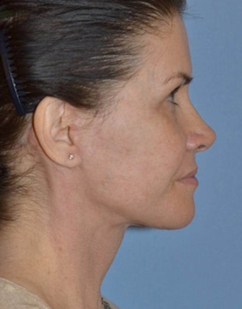 Lower Face & Neck Lift Before & After Gallery - Patient 350619 - Image 6