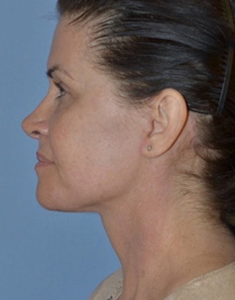 Lower Face & Neck Lift Before & After Gallery - Patient 350619 - Image 8