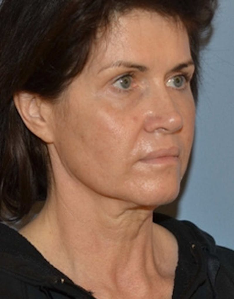 Lower Face & Neck Lift Before & After Gallery - Patient 350619 - Image 9